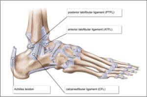 What is an Ankle Sprain? What to Expect from your Athletic Trainer ...